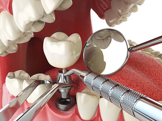Best Knocked-Out Tooth (Avulsed Tooth) Treatment in Waikapu, HI